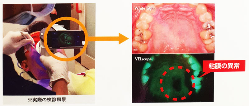 口腔内健康観察装置による口腔内検診